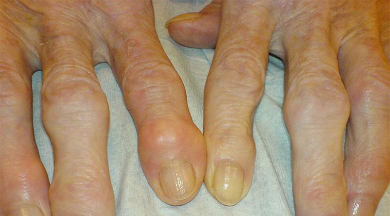 Артрит пальцев рук – причины, симптоматика, диагностика, лечение