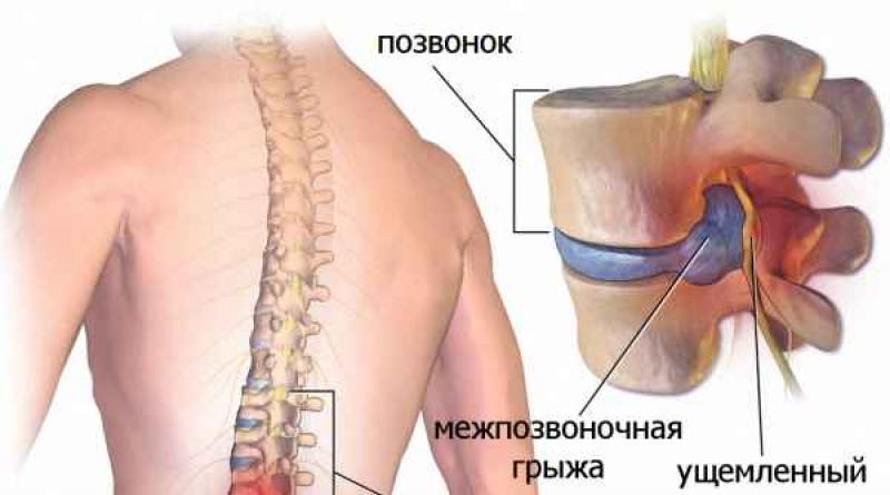 Fisioterapia para la hernia de columna lumbar.