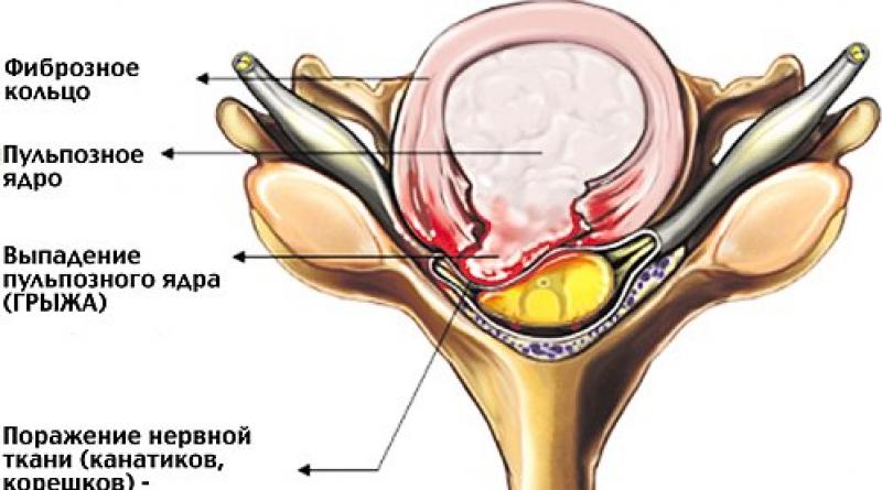 Signos de hernia intervertebral