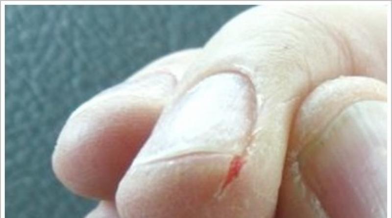 Трещины на пальцах рук: причины появления, домашние средства лечения — мази, ванночки, маски