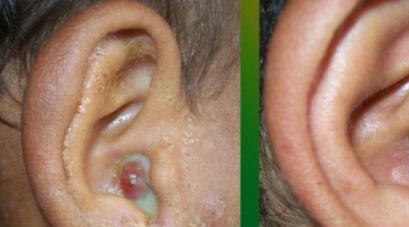 ¿Cómo se ve un pólipo en el oído?