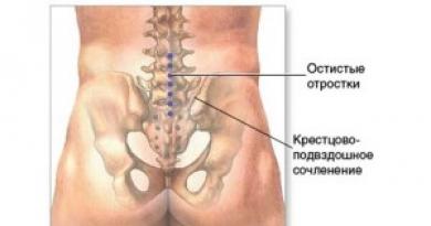 Diagnóstico y tratamiento de la osteoartritis de la articulación sacroilíaca Osteoartritis de la articulación sacroilíaca tratamiento con células madre