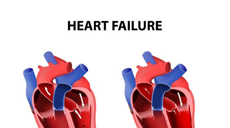 Първите признаци на сърдечна недостатъчност Какви са симптомите на сърдечна недостатъчност