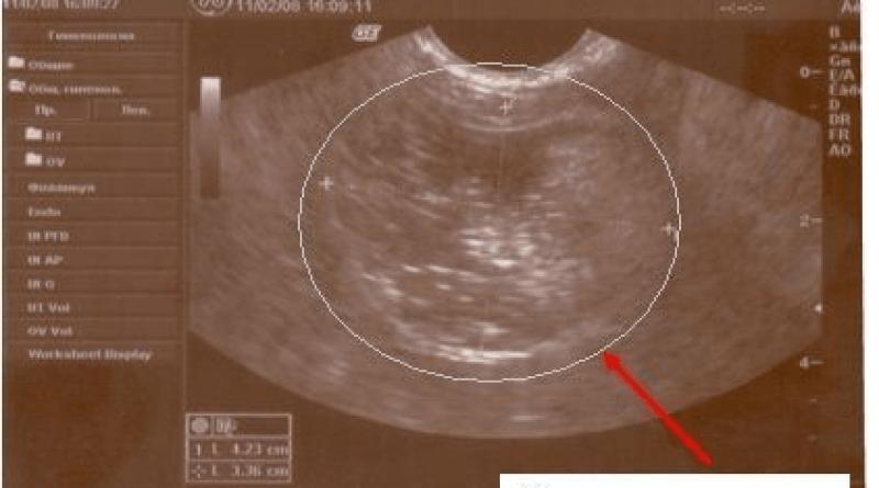 Síntomas y tratamiento del quiste dermoide del ovario izquierdo y derecho.