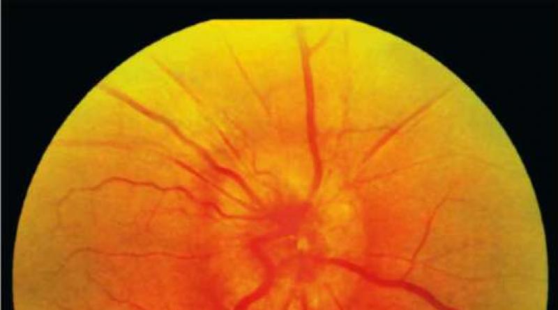 Degeneración macular asociada a la edad Signos ecográficos de drusas del nervio óptico