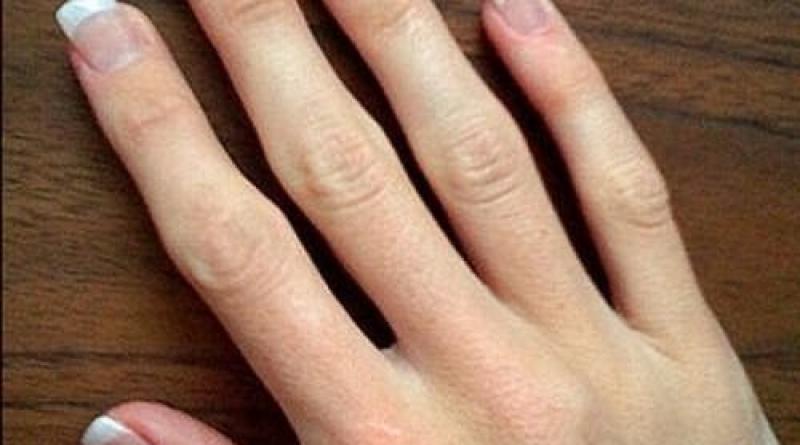 Tratamiento de las articulaciones de los dedos.