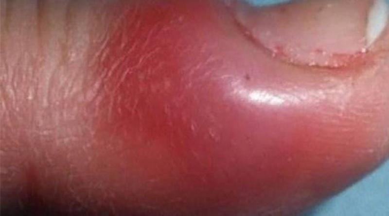 Un absceso en el dedo cerca de la uña - delincuente: ¿cómo tratarlo?